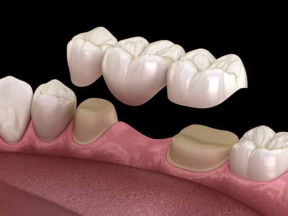 graphic of teeth with crowns