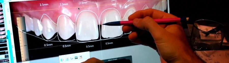 graphic of digital smile design dental tool