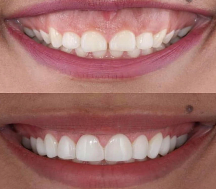 before and after laser dentistry