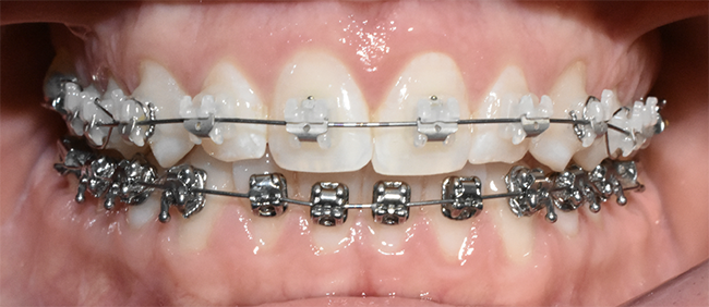 braces
