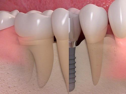 denture implants graphic
