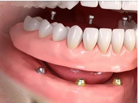 denture implant graphic