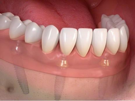 denture implant graphic