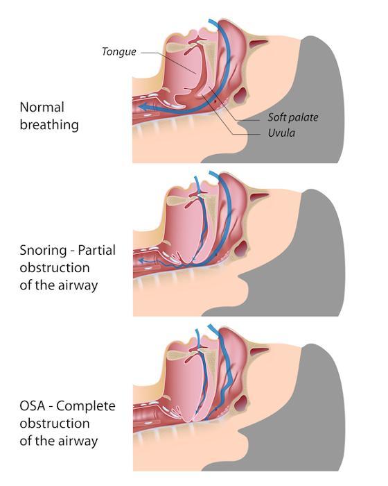 sleep apnoea graphic