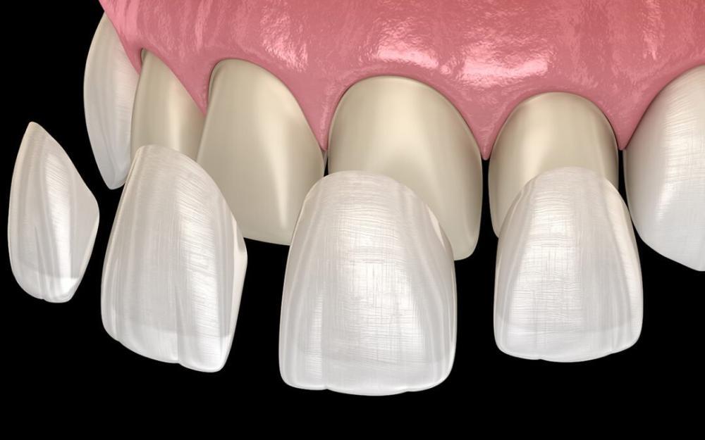 graphic of dental crowns