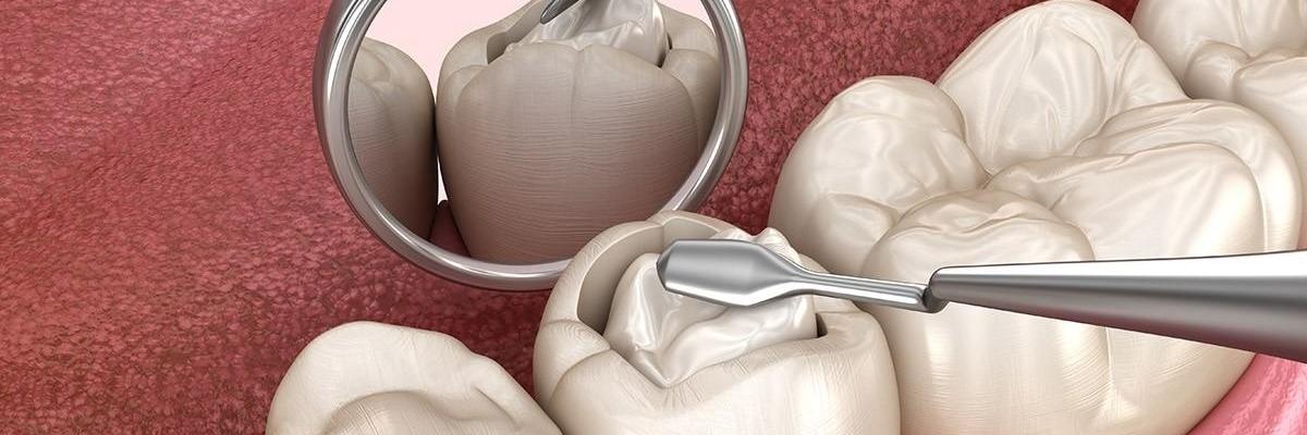 man with scarf smiling l tooth Coloured Resin Restorations in Melbourne's CBD