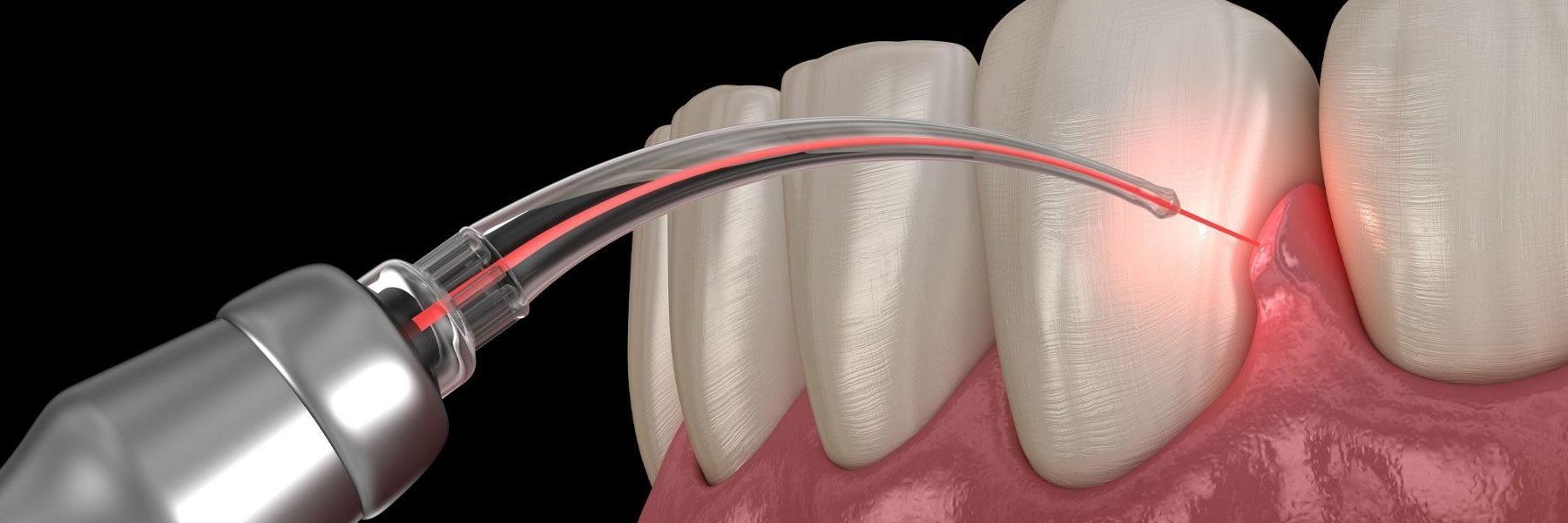 Woman smiling in dental exam chair l laser dentistry melbourne cbd