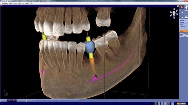 graphic of a 3d x-ray cone beam cbct