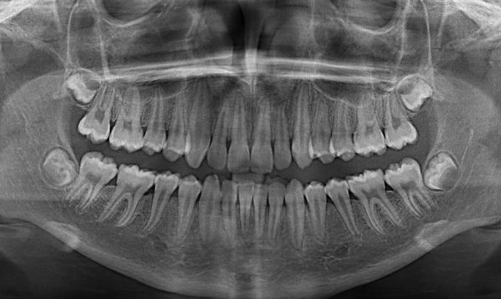 graphic of panoramic x-ray